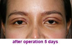 plastic-surgery-blepharoplasty